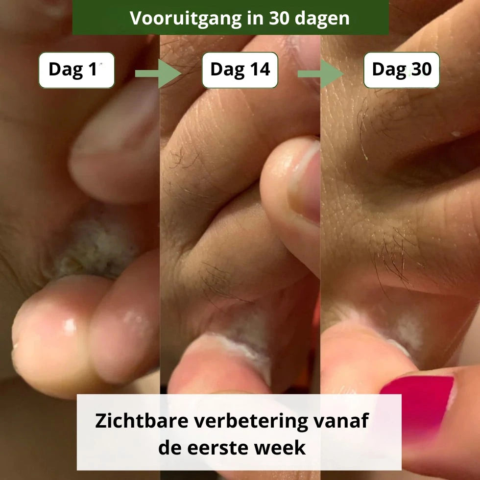 Zeep Tegen Schimmelinfecties